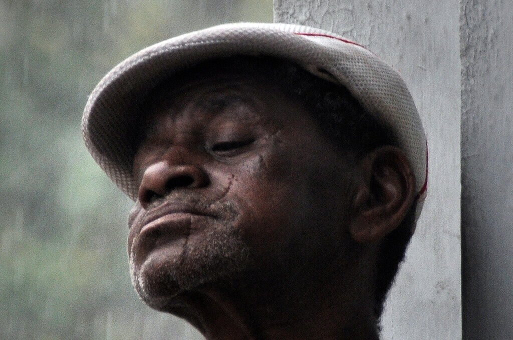 photo of man with scarred face