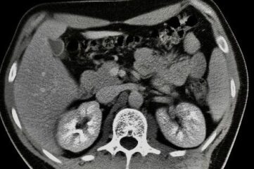 x-ray image of a brain tumour